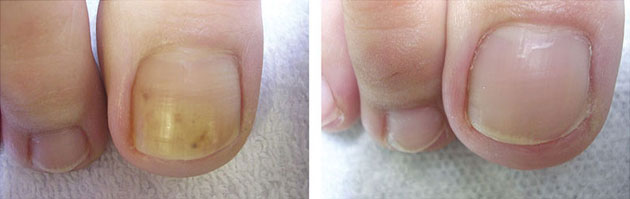 Anti Fungal Toe Tincture Spray Manicures Pedicures