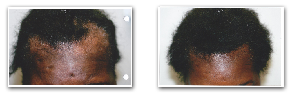 ba hairgrowth1 1 Before and After