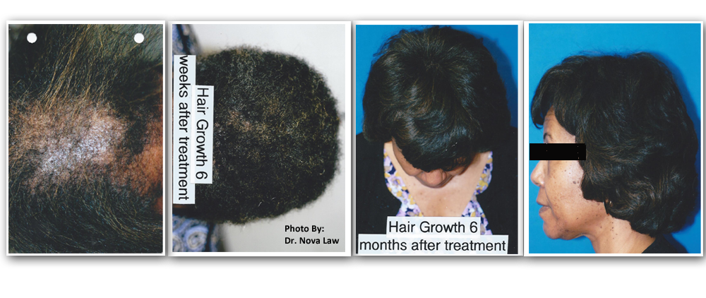 ba hairgrowth2 Before and After
