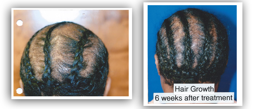 ba hairgrowth3 Before and After