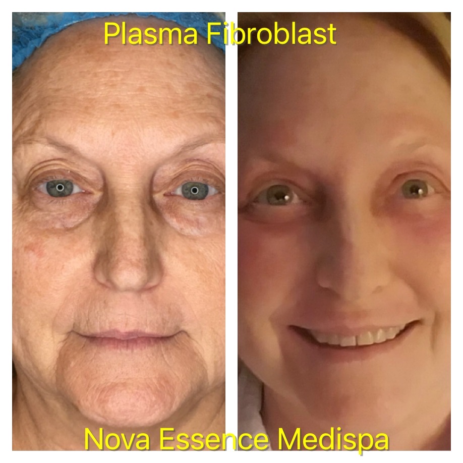 Plasmafibroblast Before and After